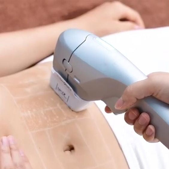 HIFU Abdomen 3 sesiones