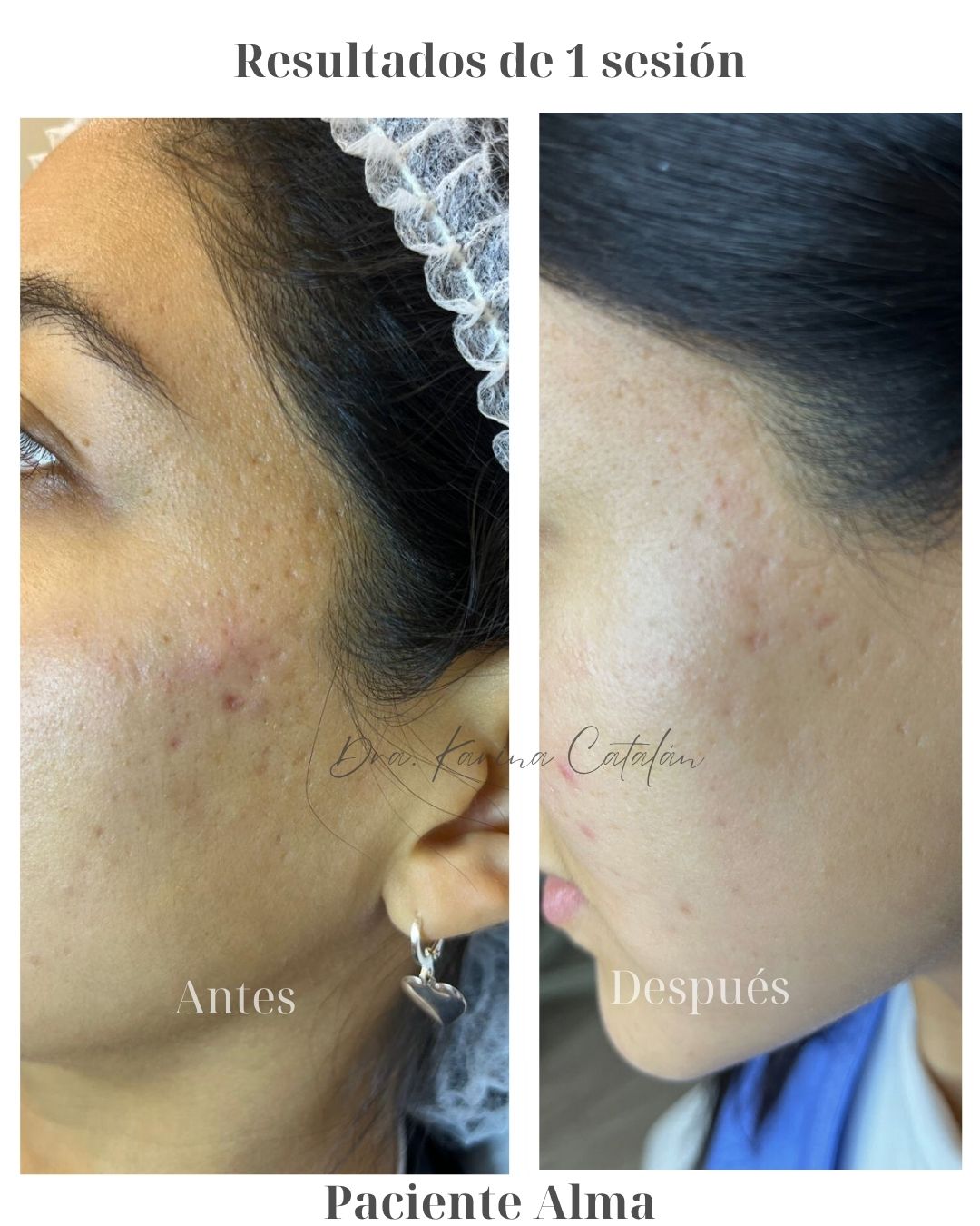 Polinucleótidos + Niacinamida 1 sesión