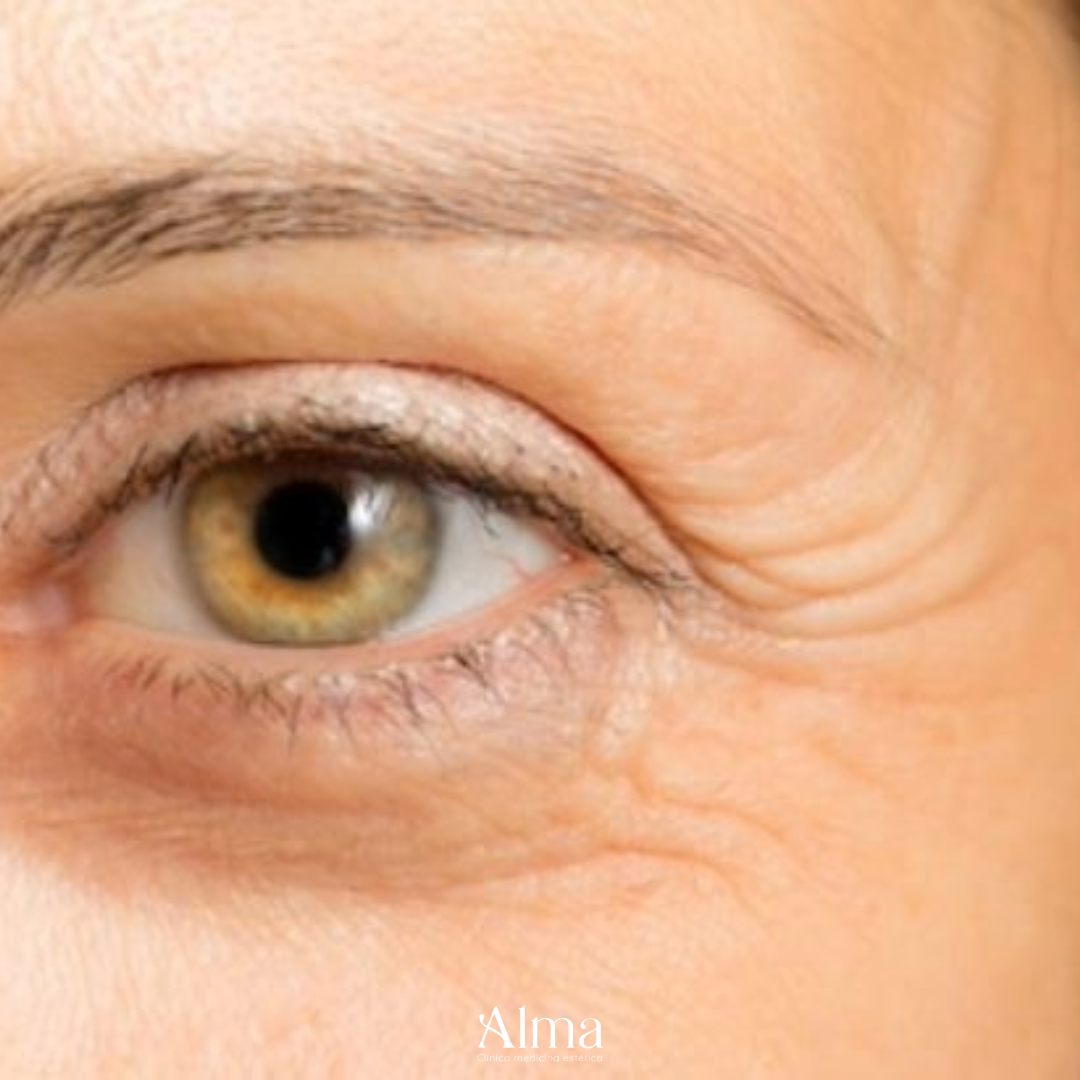 HIFU Patas de gallo (1 sesión)