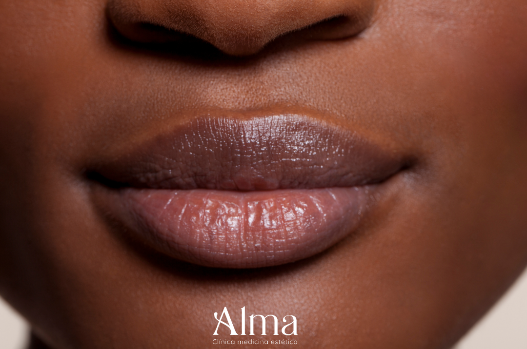 Modelación Labial con ácido hialurónico