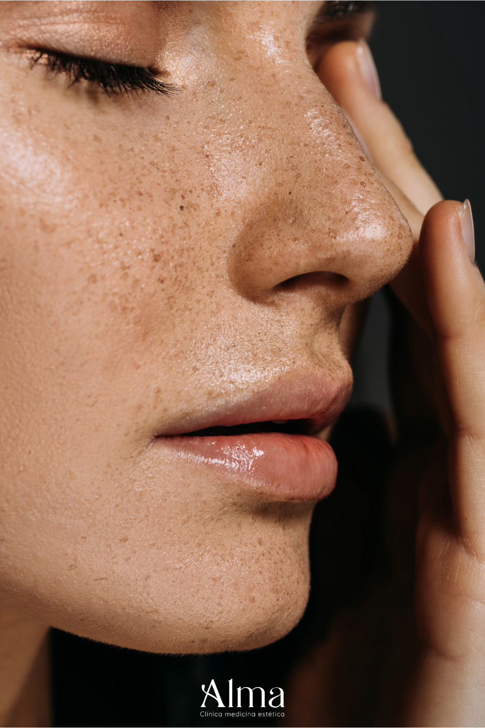 Rinomodelación con ácido Hialurónico