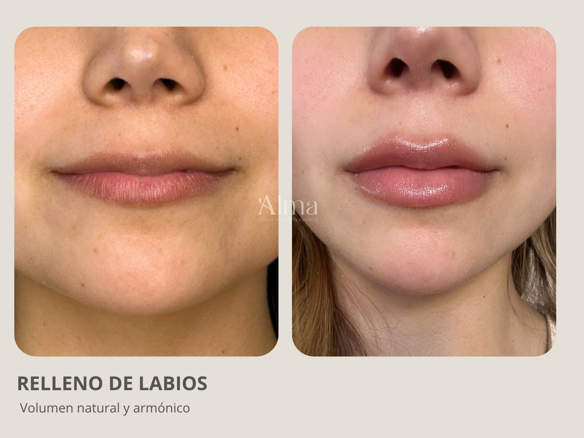 Modelación Labial con ácido hialurónico