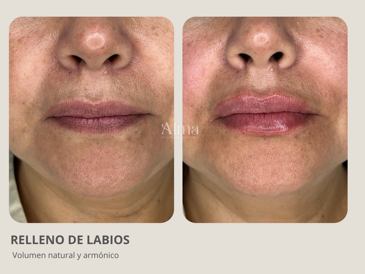 Modelación Labial con ácido hialurónico
