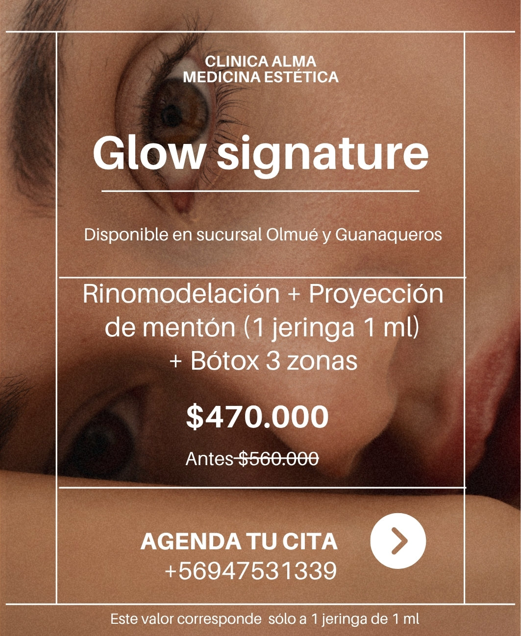 Glow signature (rinomodelación + proyección de mentón + Bótox 3 zonas)