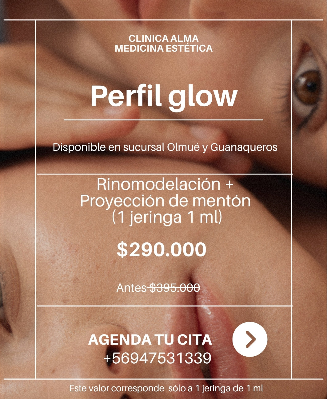Perfil Glow (Rinomodelación + proyección de mentón)