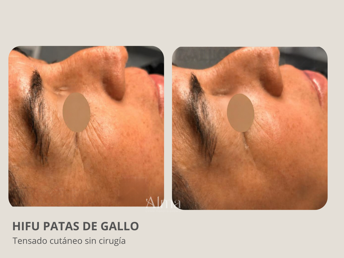 HIFU Patas de gallo (1 sesión)