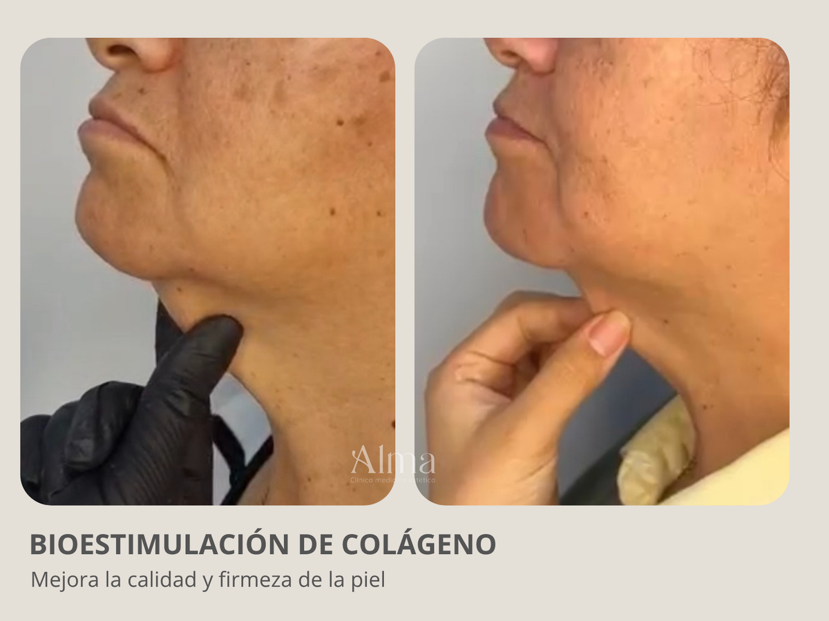 Hydroxyfill 1 sesión