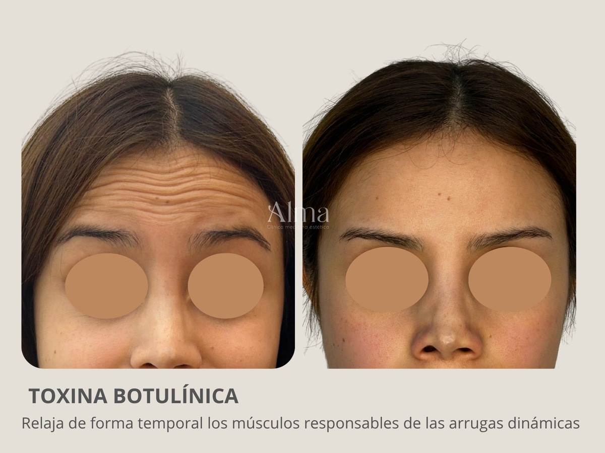 Bótox tercio superior. Elige las zonas