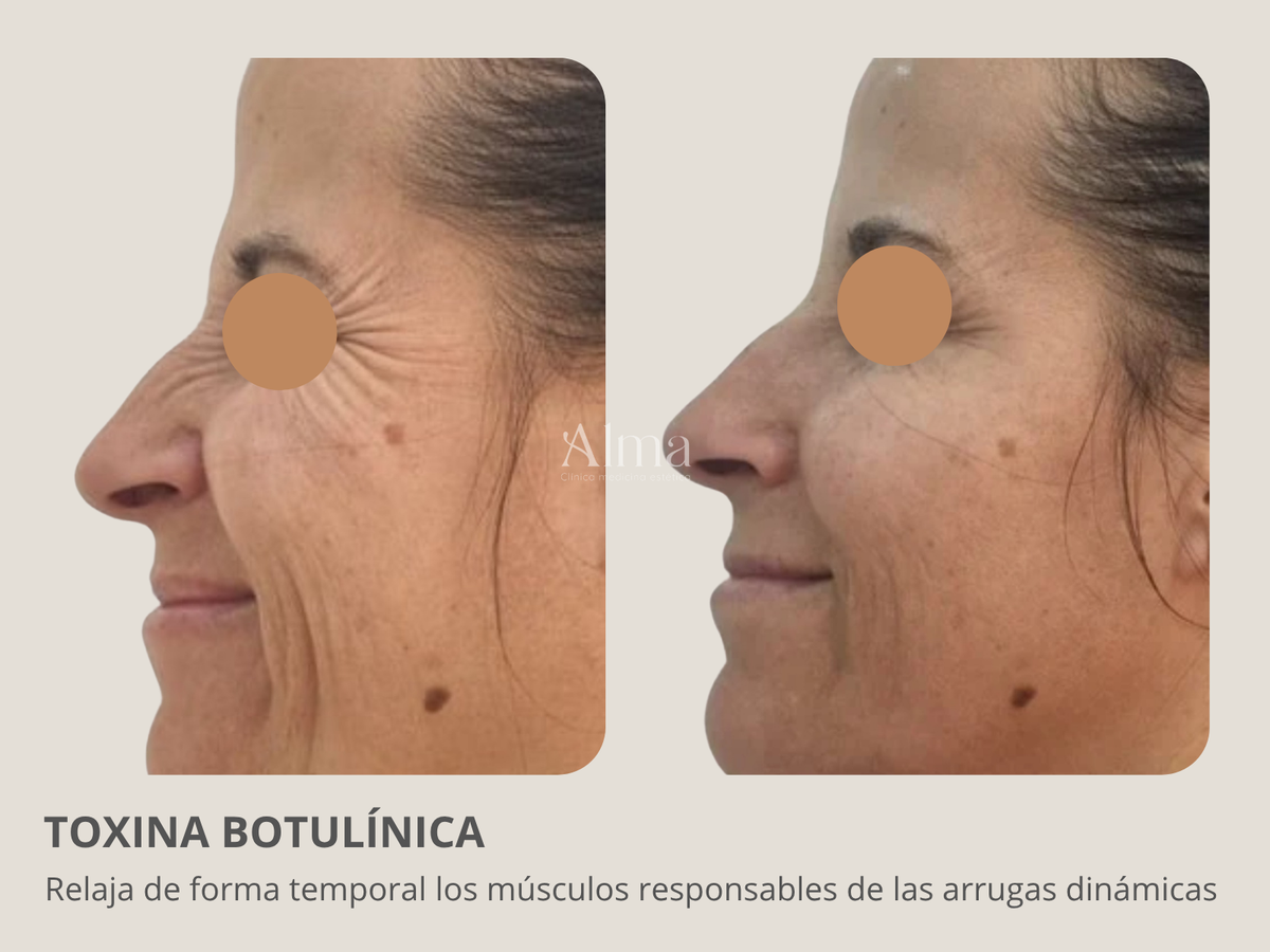 Bótox tercio superior. Elige las zonas