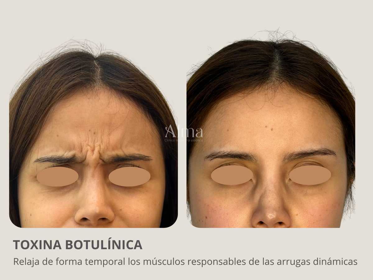 Bótox tercio superior. Elige las zonas