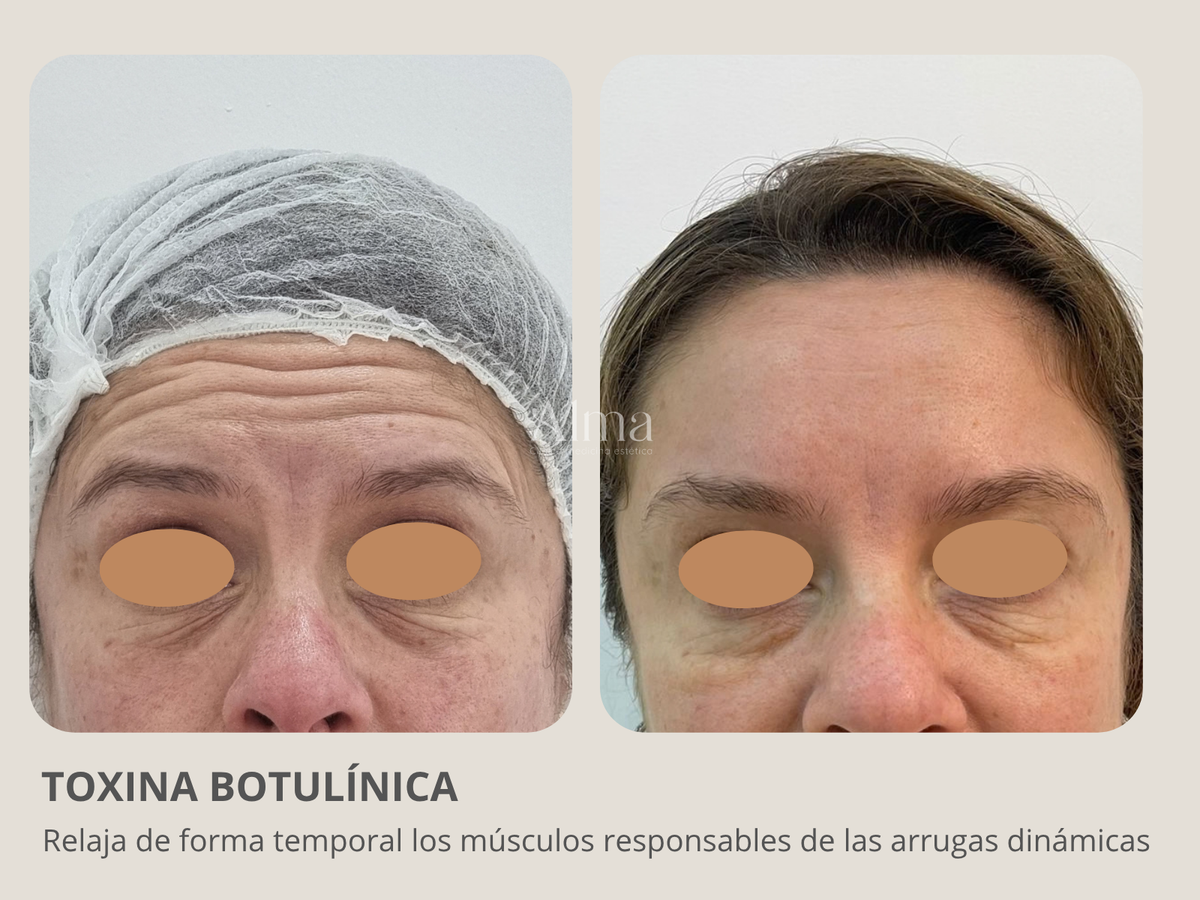 Bótox tercio superior. Elige las zonas