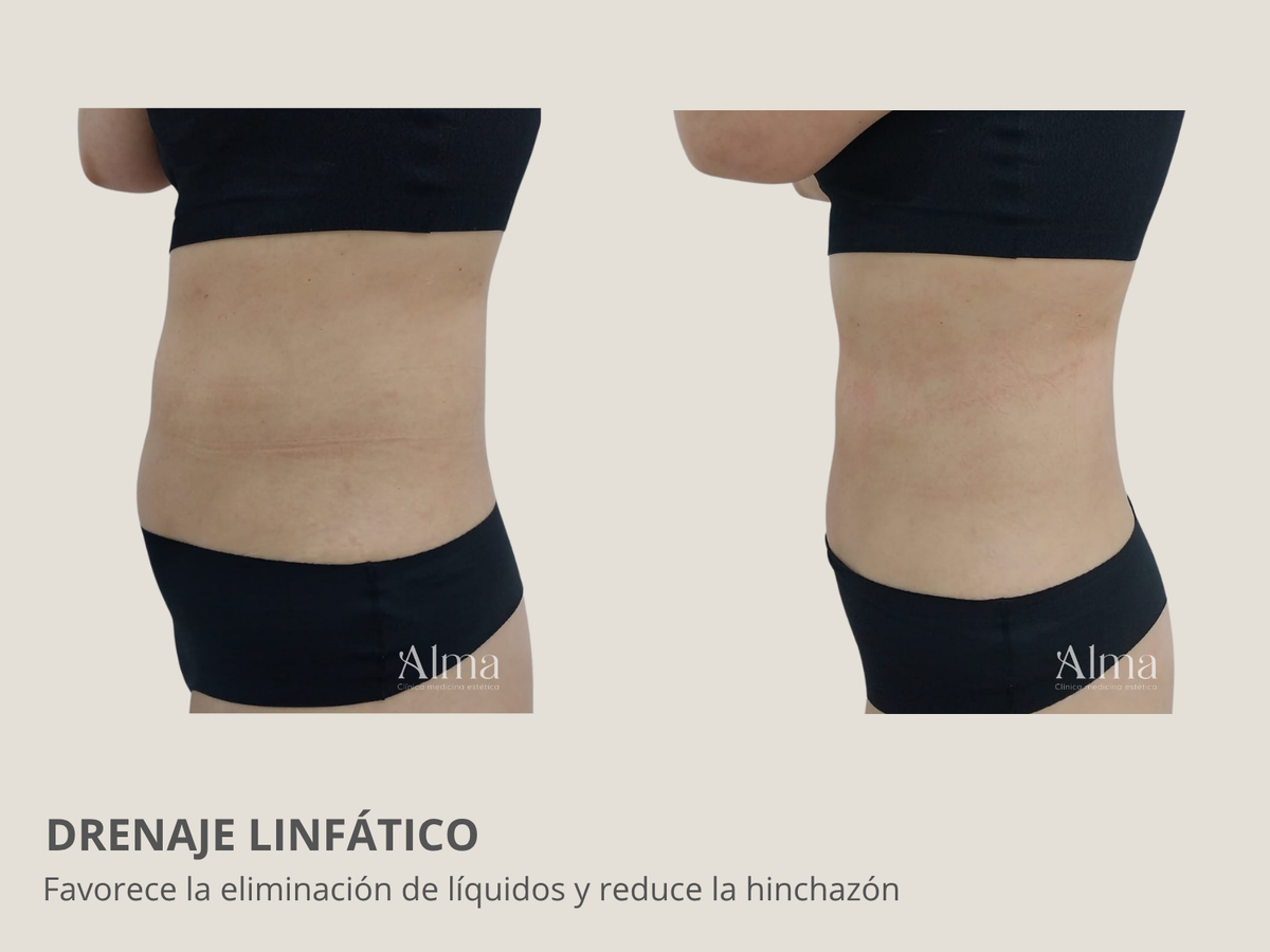 Terapia roller: drenaje linfático