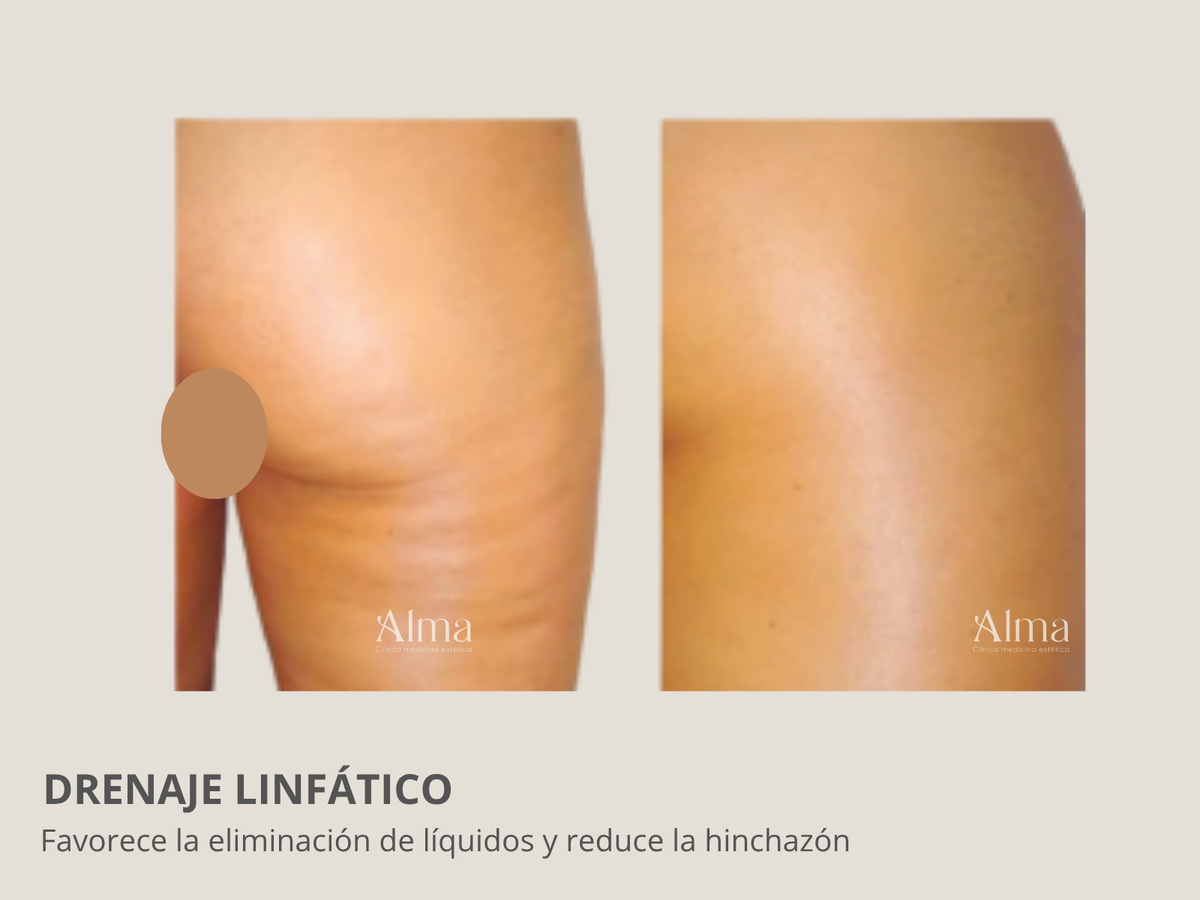 Terapia roller: drenaje linfático