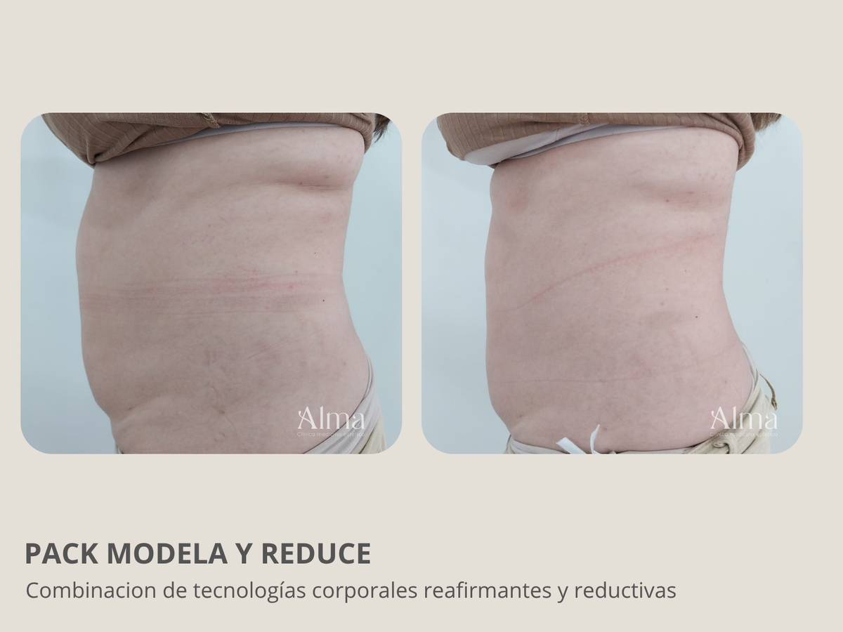Pack Modela y Reduce