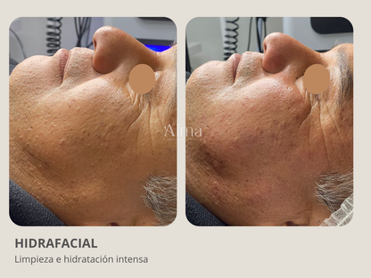 Plan Hidrafacial: 3 sesiones