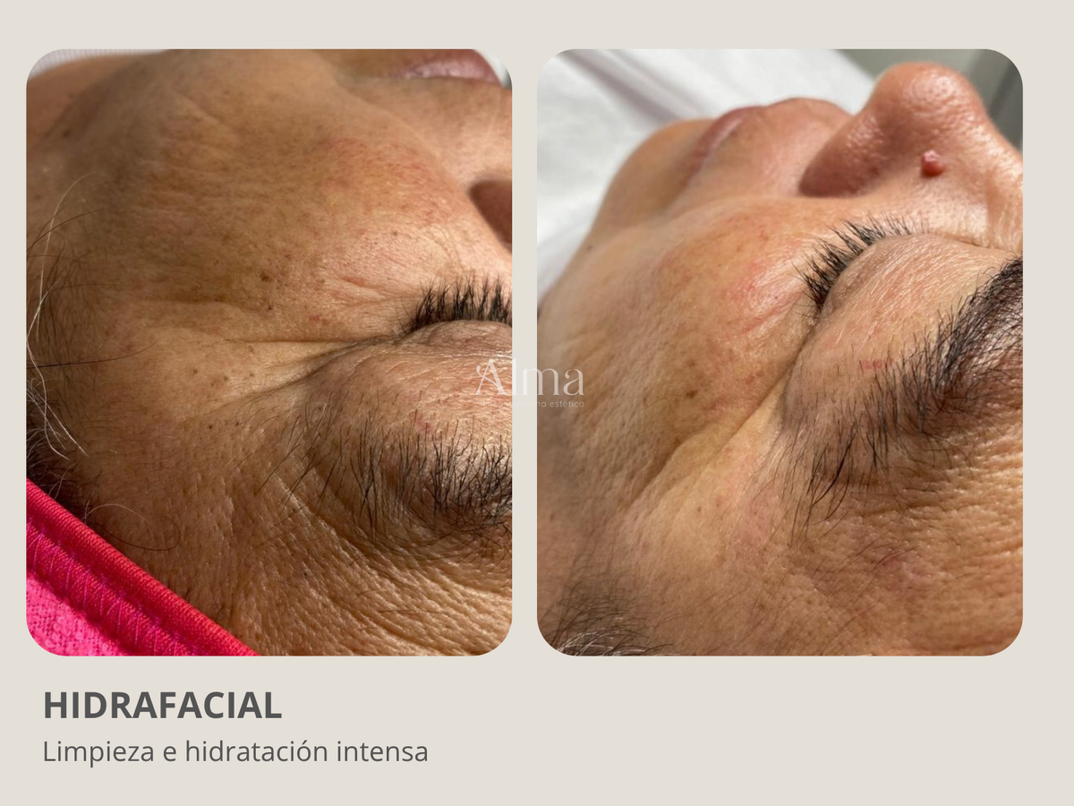 Plan Hidrafacial: 3 sesiones