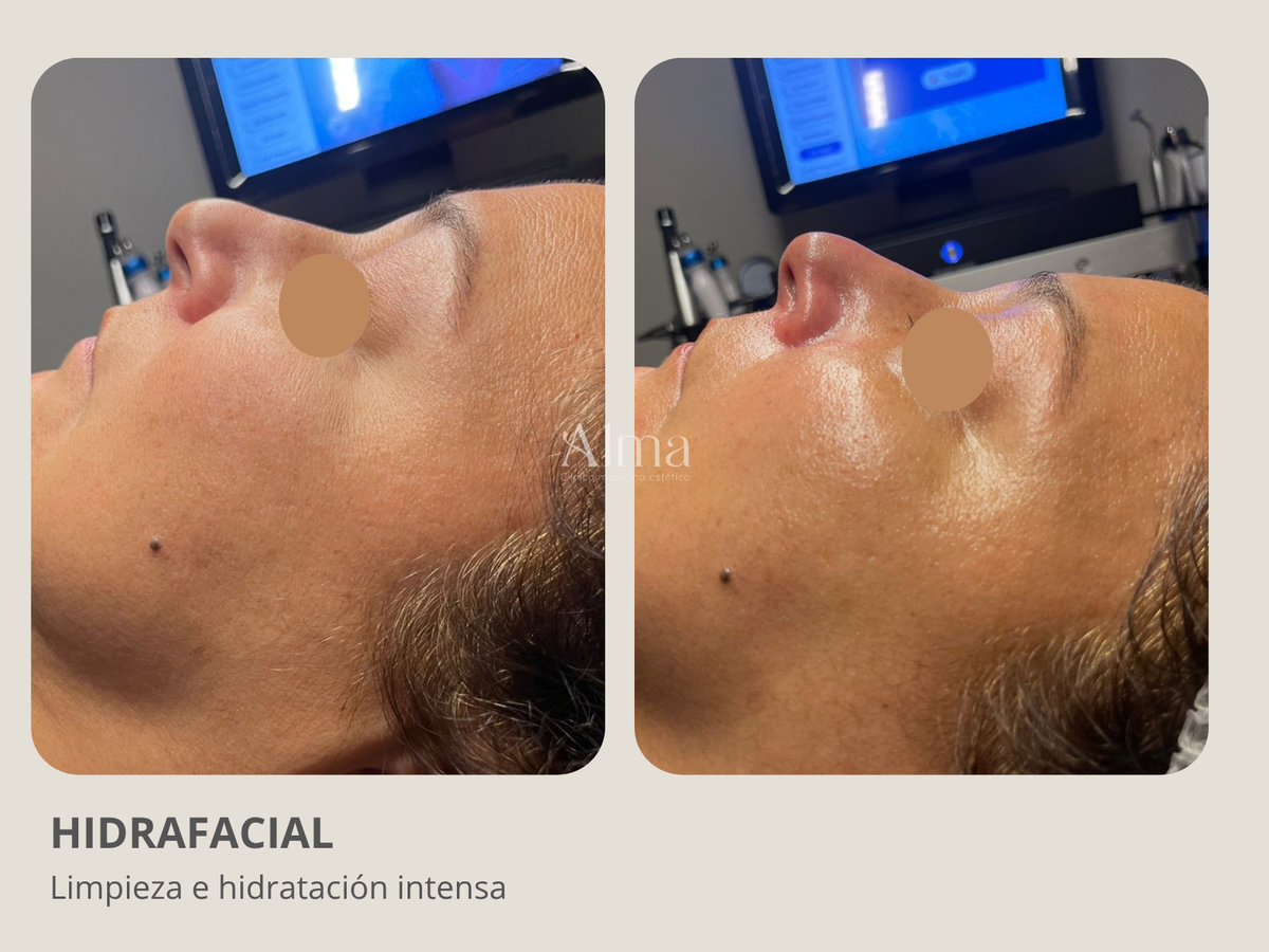 Hidrafacial: Limpieza facial profesional profunda