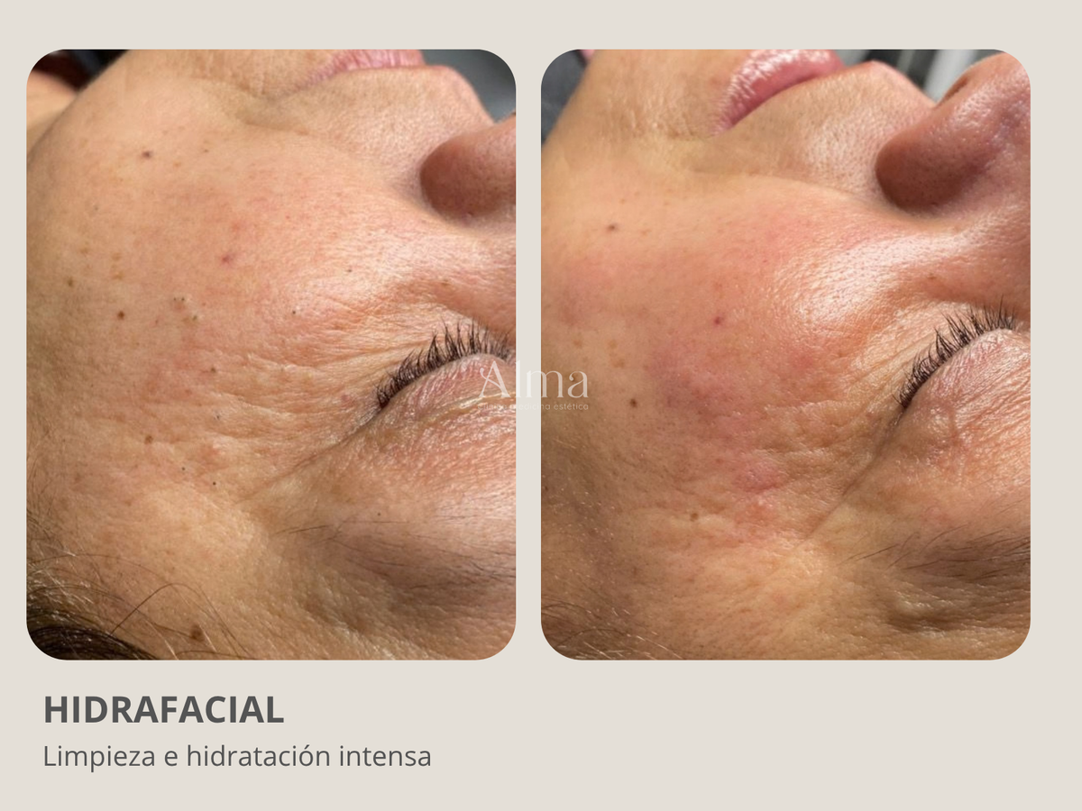 Hidrafacial: Limpieza facial profesional profunda