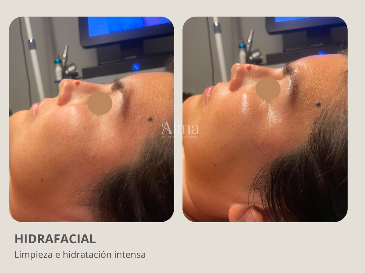 Hidrafacial: Limpieza facial profesional profunda