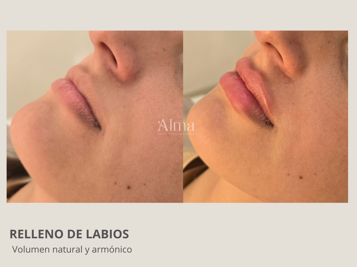 Modelación Labial con ácido hialurónico