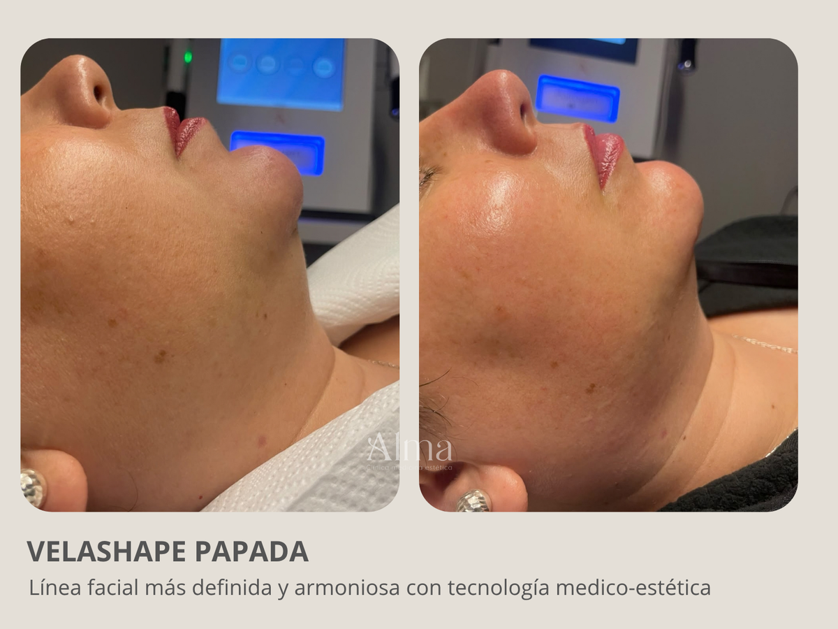 Velashape papada