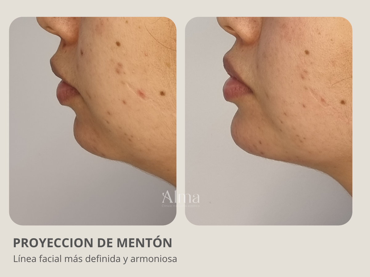 Proyección de mentón con ácido hialurónico