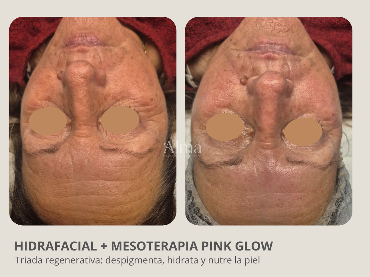 Hidrafacial + Mesoterapia Pink glow