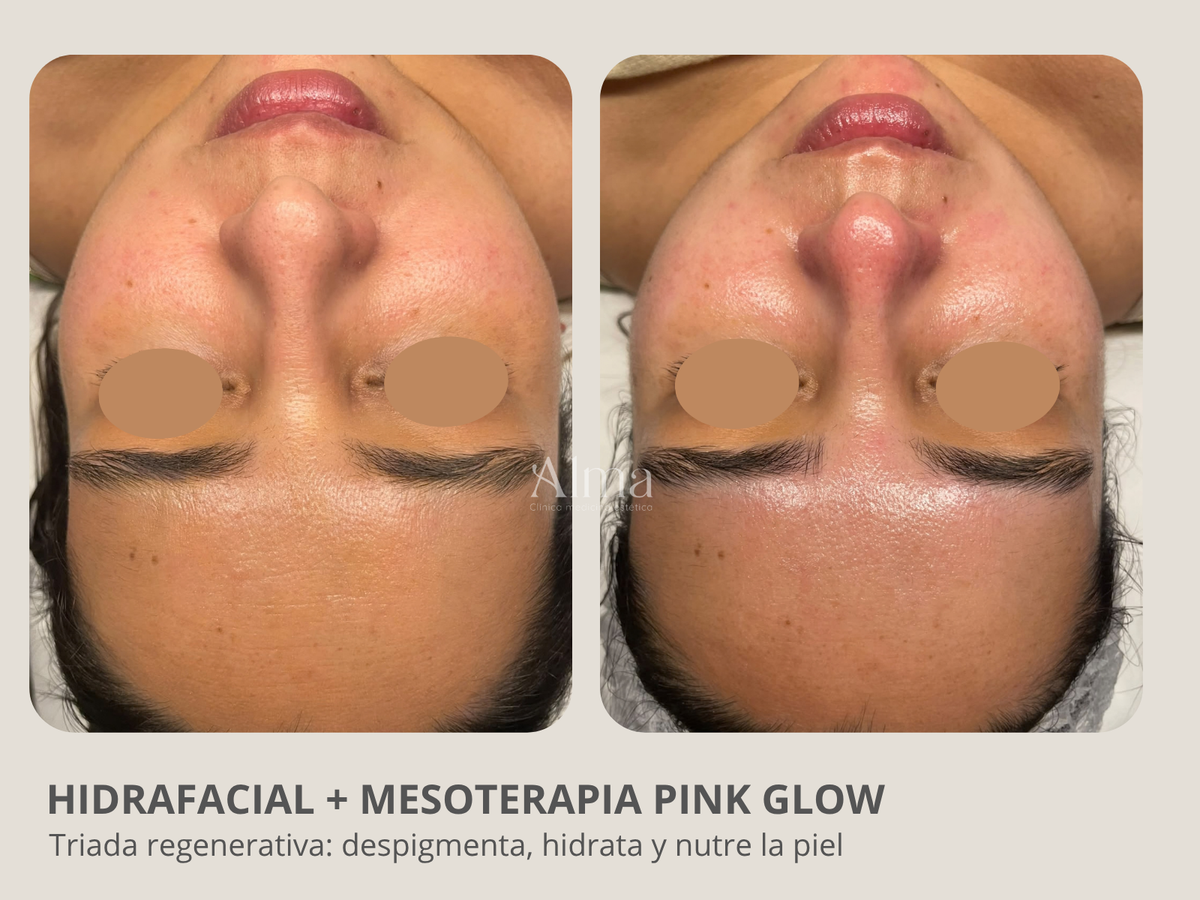 Hidrafacial + Mesoterapia Pink glow