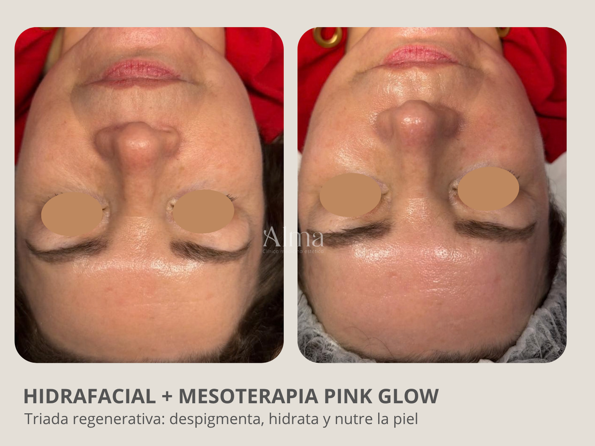 Hidrafacial + Mesoterapia Pink glow
