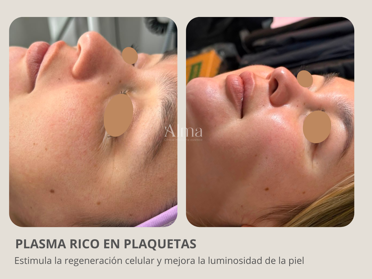 1 sesión Plasma rico en plaquetas + pink glow