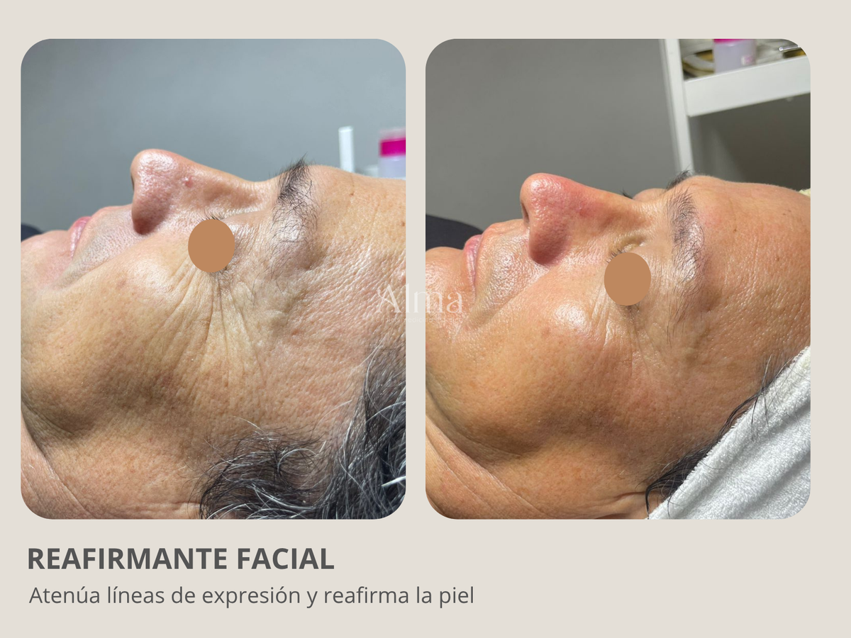 Reafirmante facial