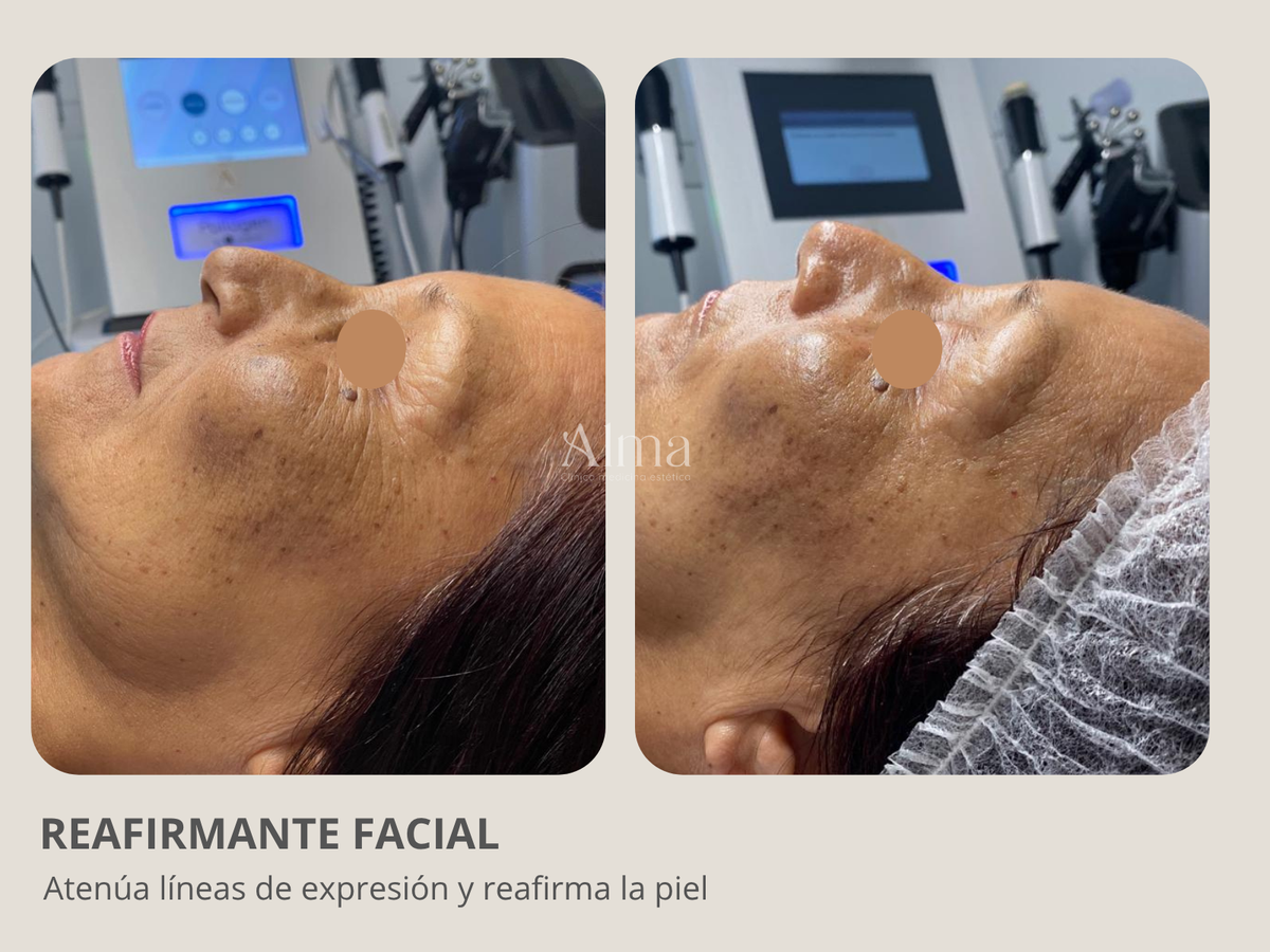 Reafirmante facial