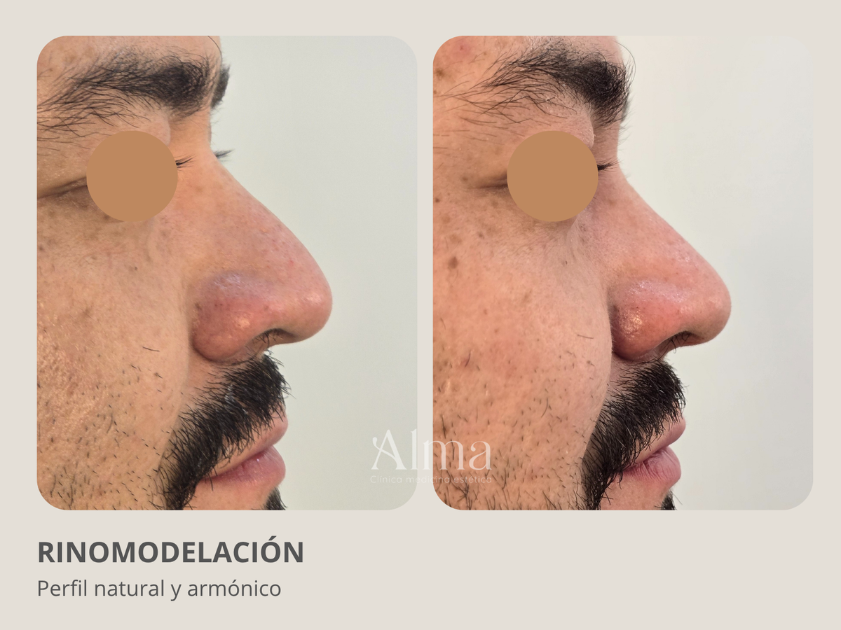 Rinomodelación con ácido Hialurónico